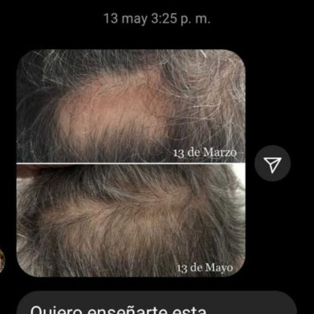 Testimonio Champú anticaída